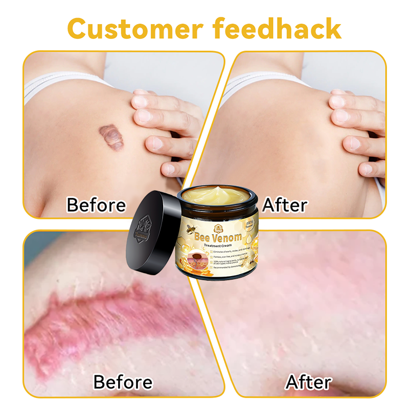 Remove moles instantly🎁(Last day for a limited time: 80% OFF )💥𝑇𝑢𝑟𝑜𝑛𝑢™ Bee Venom Skin Treatment Cream（𝐴𝐴𝐷 𝑅𝑒𝑐𝑜𝑚𝑚𝑒𝑛𝑑𝑒𝑑）