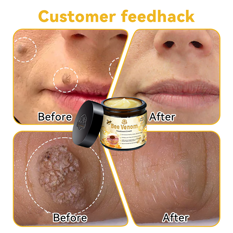 Remove moles instantly🎁(Last day for a limited time: 80% OFF )💥𝑇𝑢𝑟𝑜𝑛𝑢™ Bee Venom Skin Treatment Cream（𝐴𝐴𝐷 𝑅𝑒𝑐𝑜𝑚𝑚𝑒𝑛𝑑𝑒𝑑）