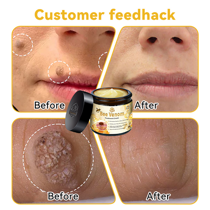 Remove moles instantly🎁(Last day for a limited time: 80% OFF )💥𝑇𝑢𝑟𝑜𝑛𝑢™ Bee Venom Skin Treatment Cream（𝐴𝐴𝐷 𝑅𝑒𝑐𝑜𝑚𝑚𝑒𝑛𝑑𝑒𝑑）