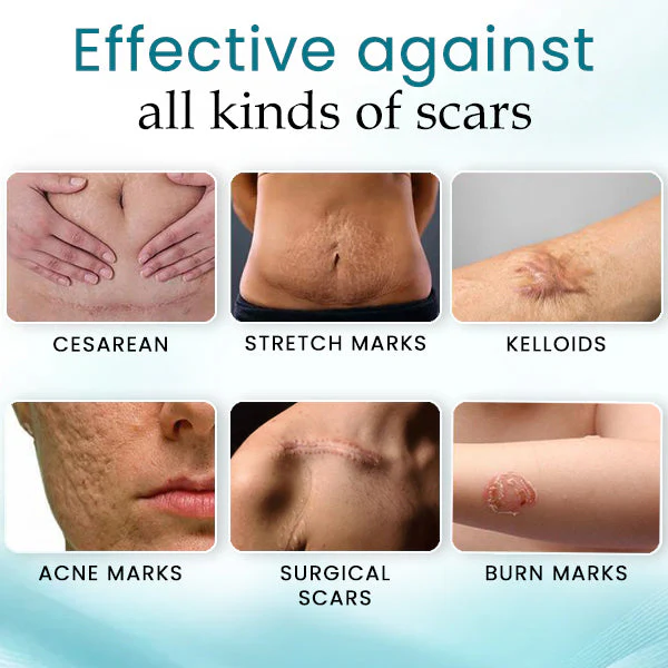 Advanced 💧LEFUN™ Scar spray For All Types of Scars -For example Acne Scars,Surgical Scars andStretch Marks